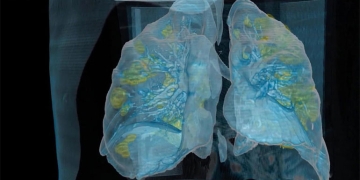 Video en 3D revela el ataque que le hace el coronavirus a los pulmones