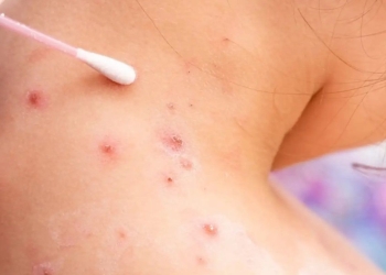 Viruela del mono en Colombia: ¿Qué tan contagiosa es?