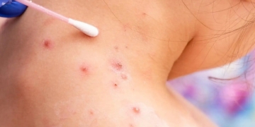 Viruela del mono en Colombia: ¿Qué tan contagiosa es?