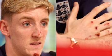 ¡El jugador de Inglaterra que se lesionó por montar en bicicleta!